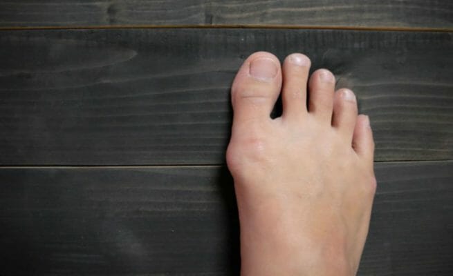 bunion