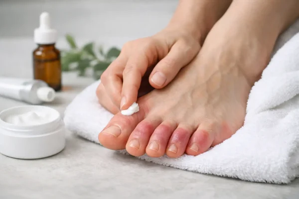 Chilblains Treatment on Feet That Actually Helps