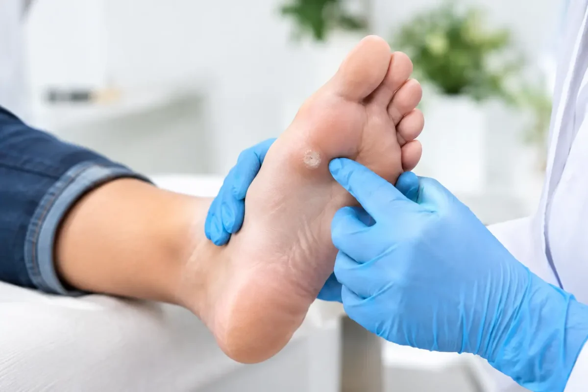 When Wart Removal Is Needed for Foot Warts